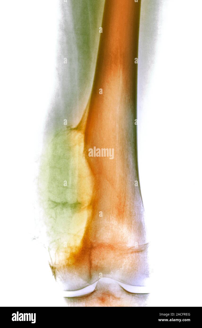 Coloured X Ray Of An Aneurysmal Bone Cyst Yellow Green Lower Left On