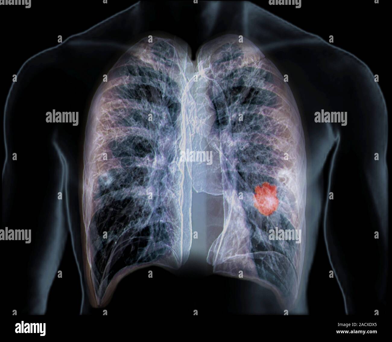 Lung Cancer Coloured Frontal D Computed Tomography Ct Scan Of A