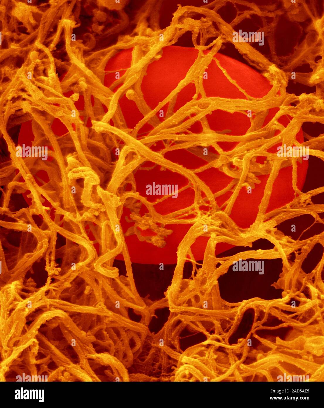 Human Red Blood Cells Trapped In A Fibrin Blood Clot Coloured Scanning