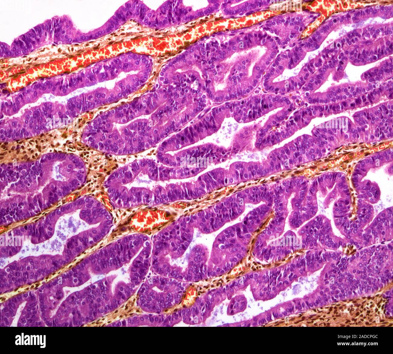 Ovarian Tumour Light Micrograph LM Of A Section Through An Ovary