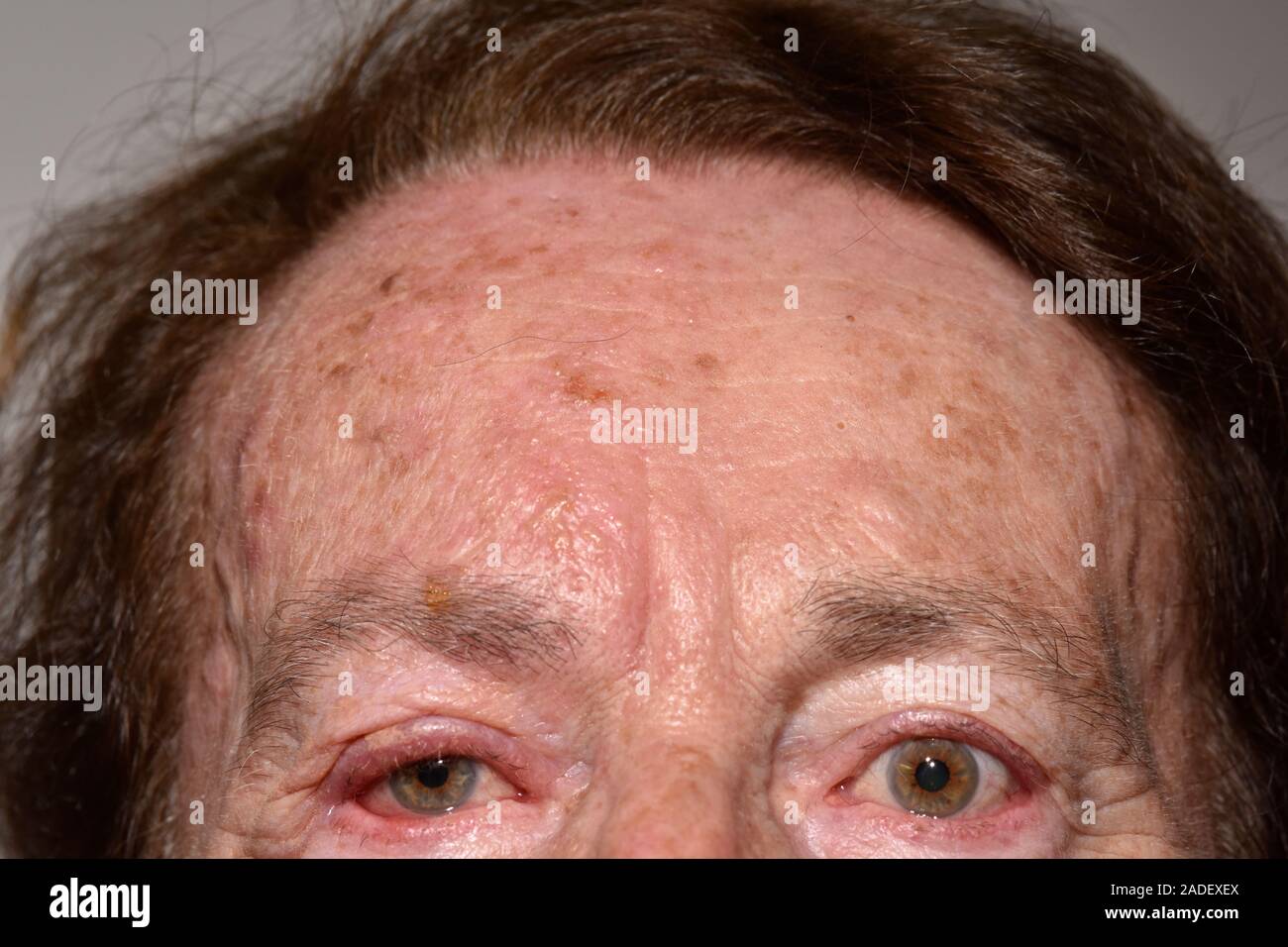 MODEL RELEASED Shingles Rash Affecting Facial Nerve Shingles Rash