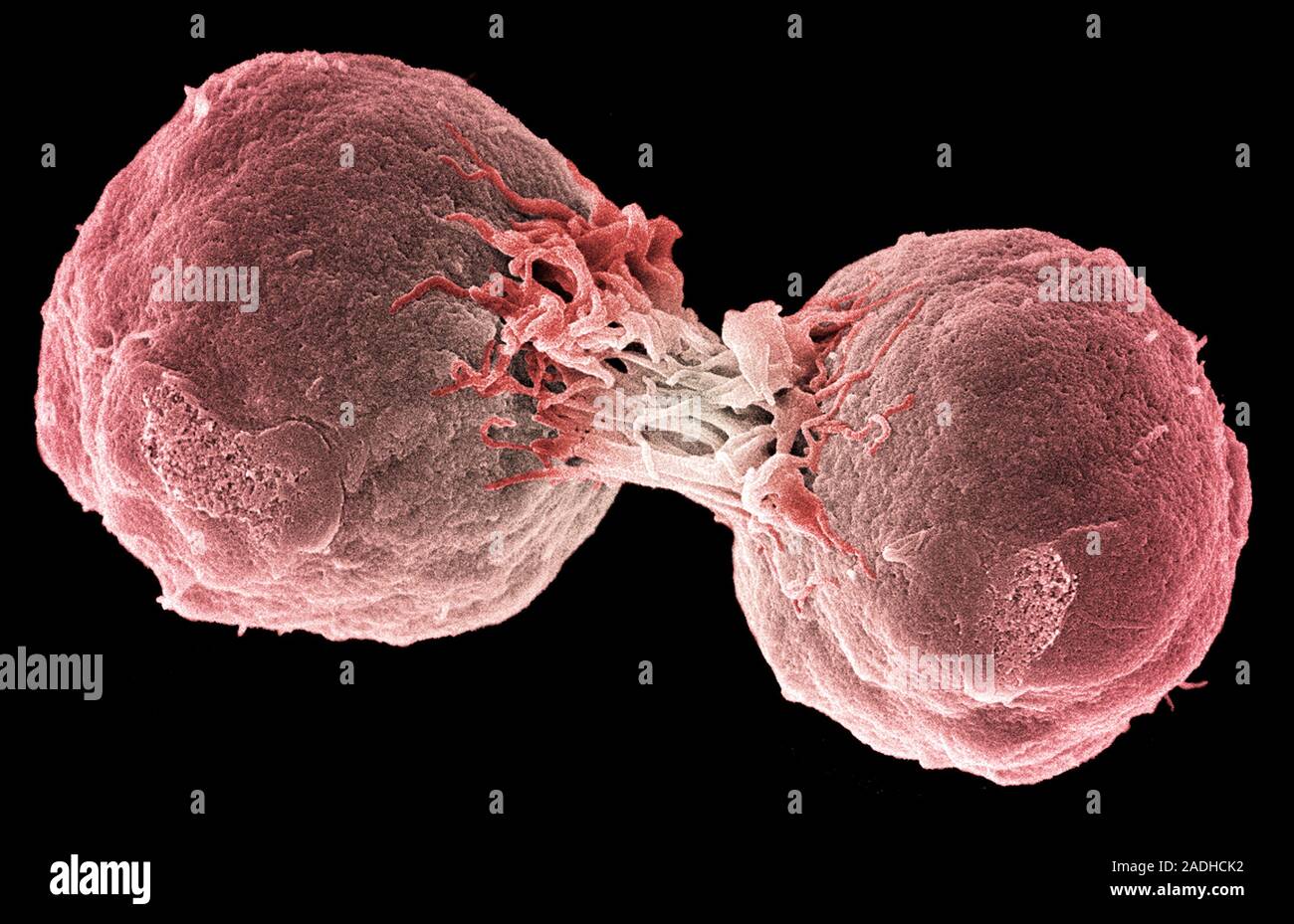 Dividing Lymphoma Cancer Cells Coloured Scanning Electron Micrograph