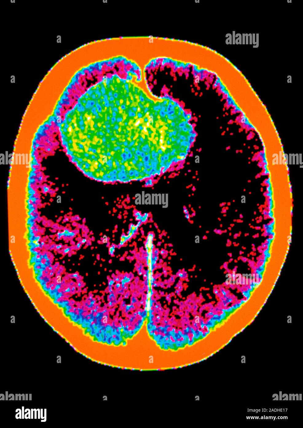 Brain Haemorrhage Coloured Computed Tomography CT Scan Showing A Subarachnoid Brain