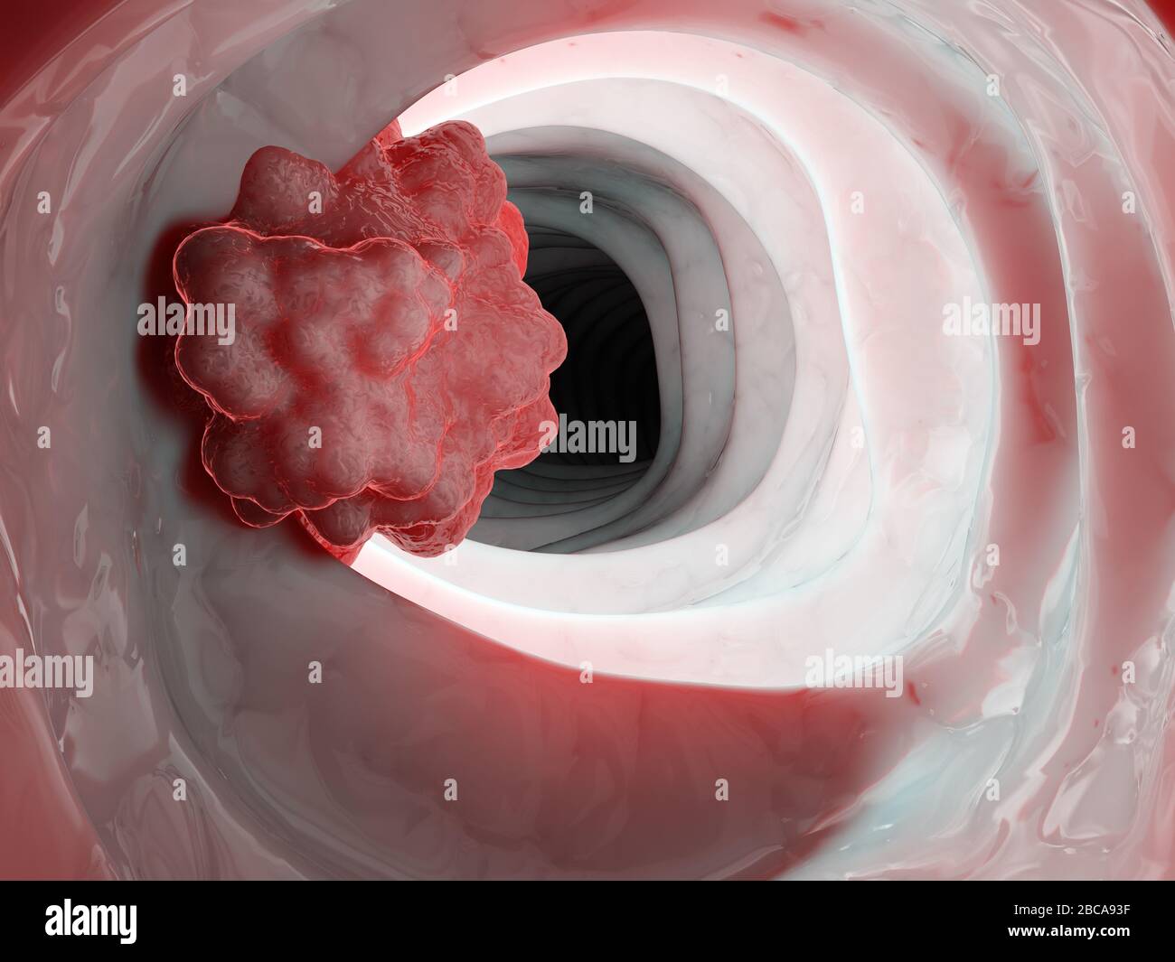 Colon Tumour Illustration Stock Photo Alamy