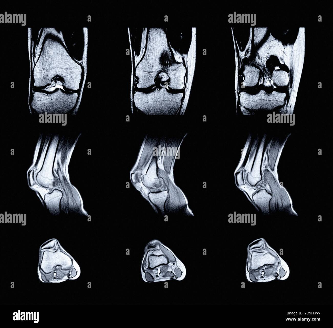 Magnetic Resonance Imaging MRI Of Right Knee Closed Injury Of The