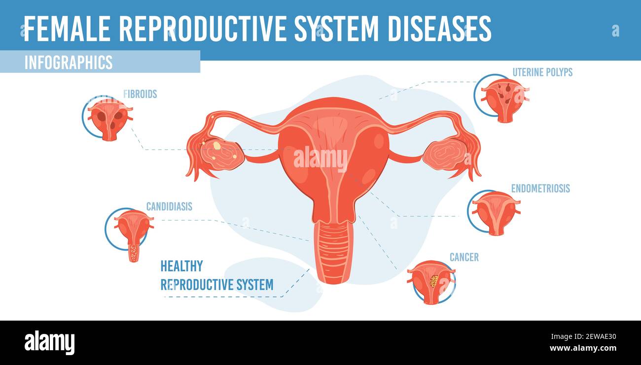 Flat Cartoon Infographic Female Reproductive System Diseases Vector