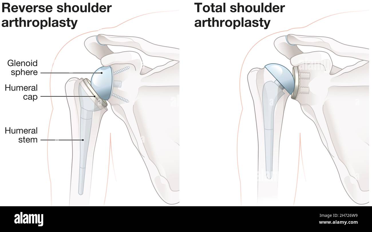 Illustration Showing Reverse Shoulder Arthroplasty And Total Shoulder