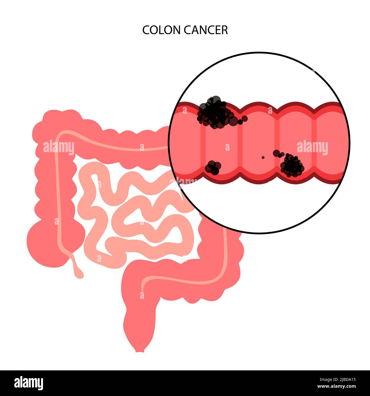 Colon Cancer Stages Illustration Stock Photo Alamy