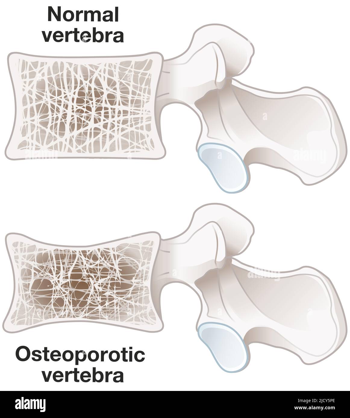 Illustration Showing Osteoporosis Normal Vertebra And Osteoporotic