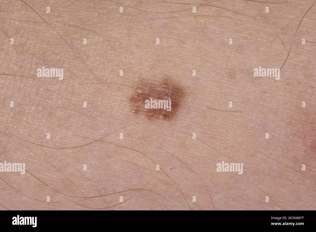 Melanoma In Situ Stock Photo Alamy