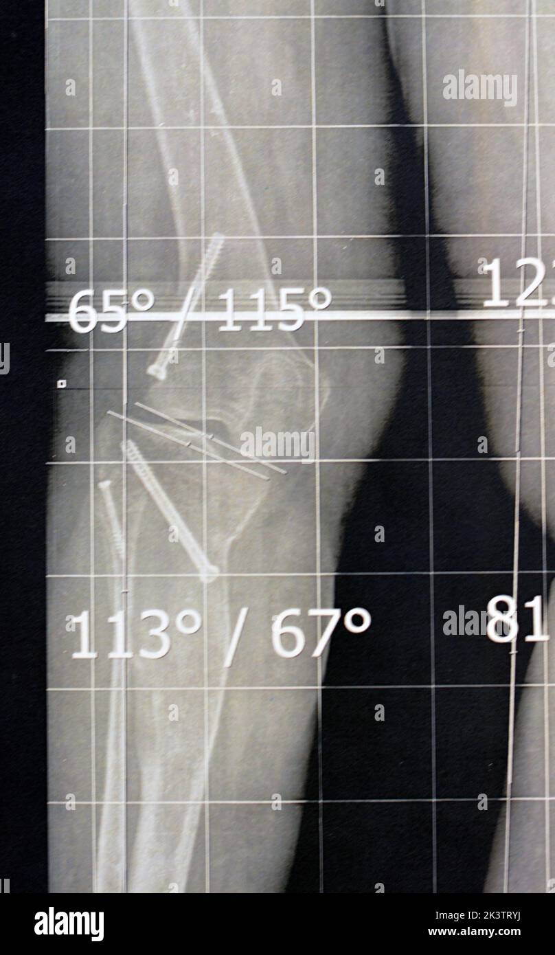 Plain X Ray Long Film Standing Position Showing Both Legs With