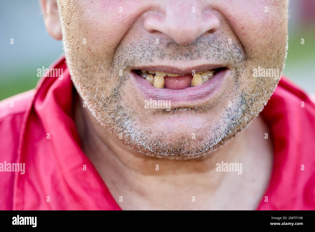 Toothless Caucasian Middle Aged Man Lower Part Of Face Close Up Stock