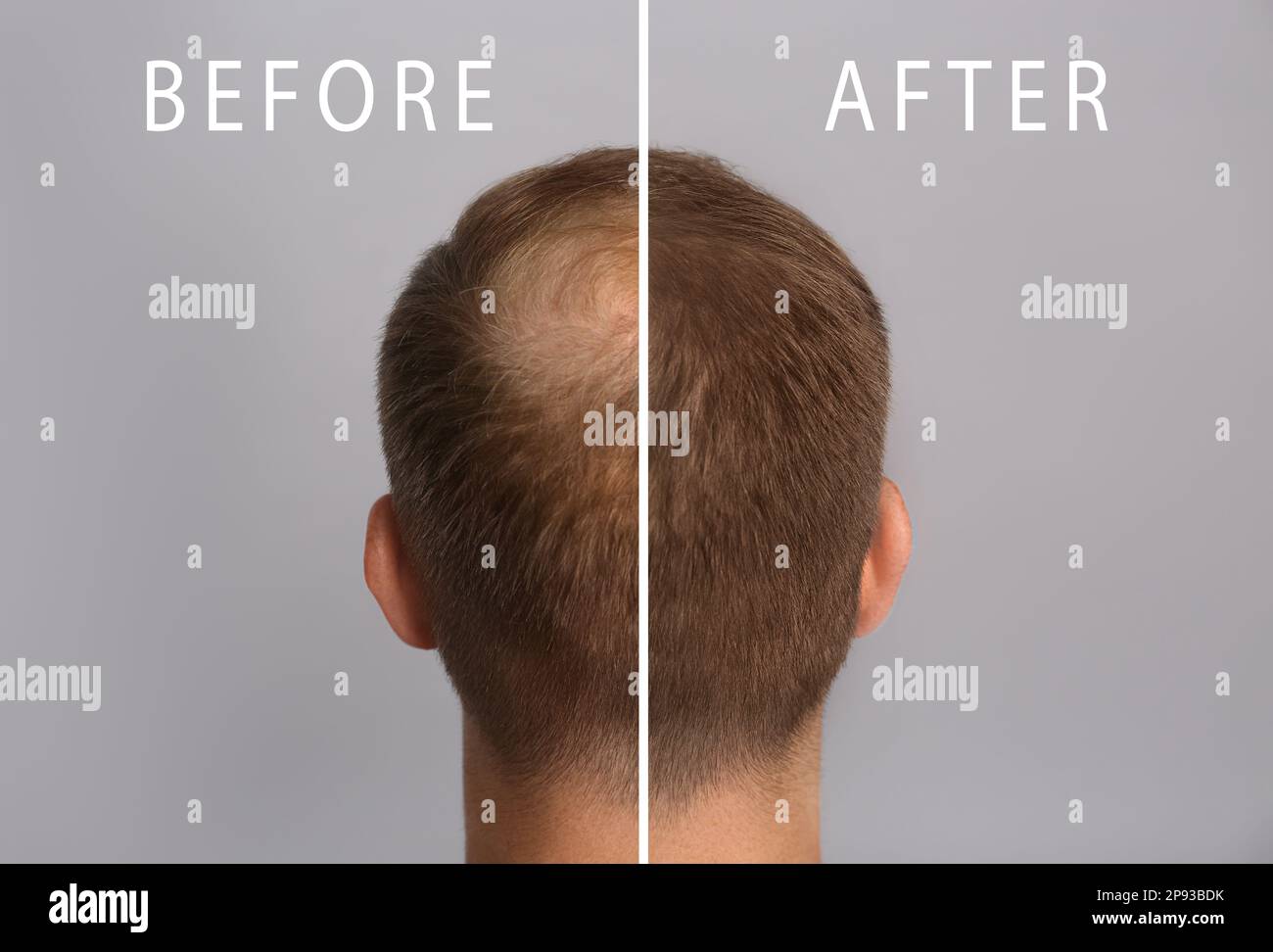 Man With Hair Loss Problem Before And After Treatment On Grey