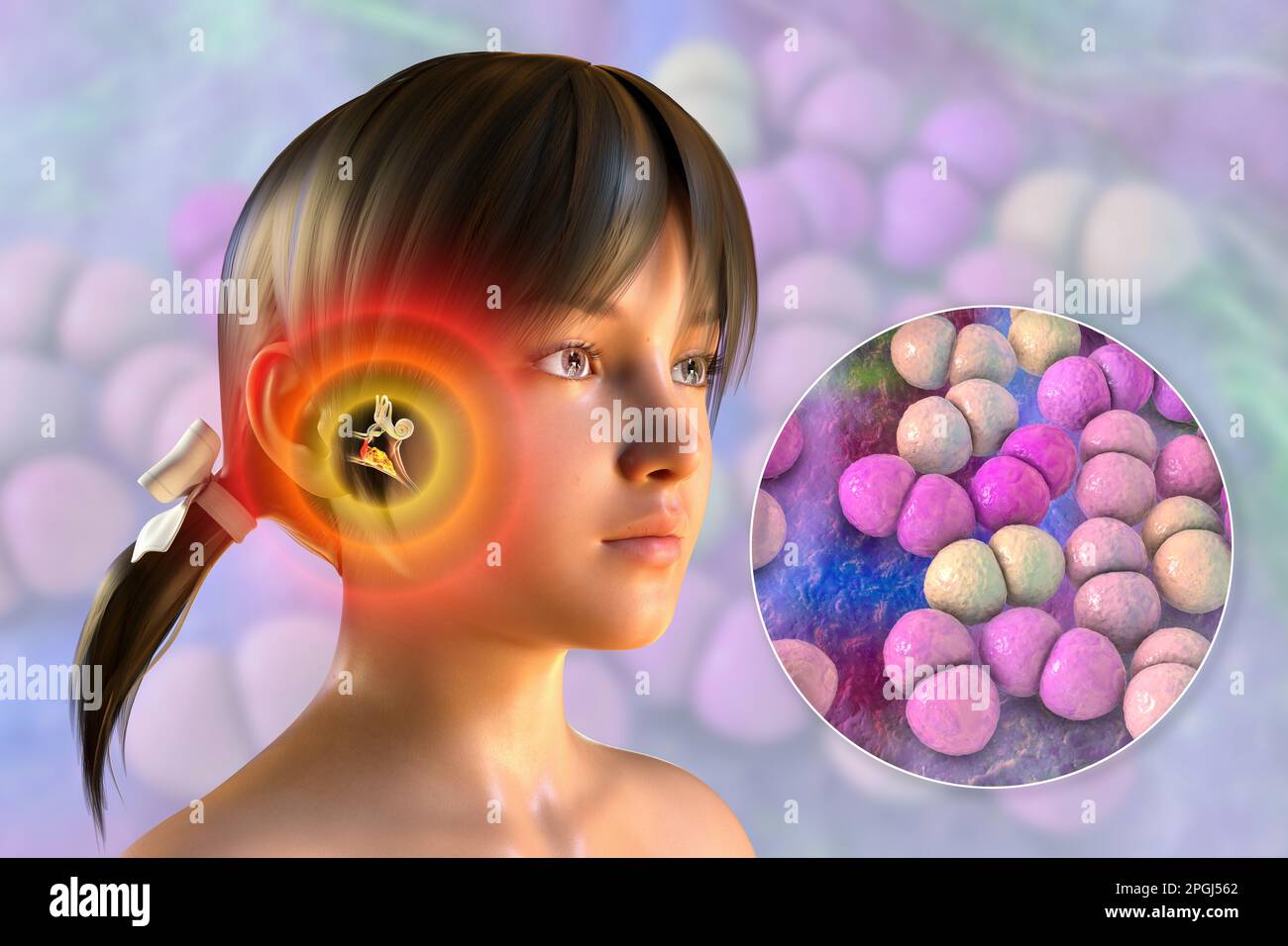 Otitis Media Ear Infection Caused By Streptococcus Pneumoniae Bacteria