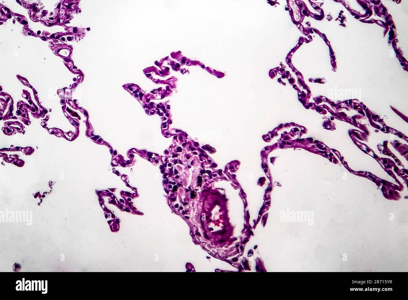 Histopathology Of Lung Emphysema Light Micrograph Photo Under