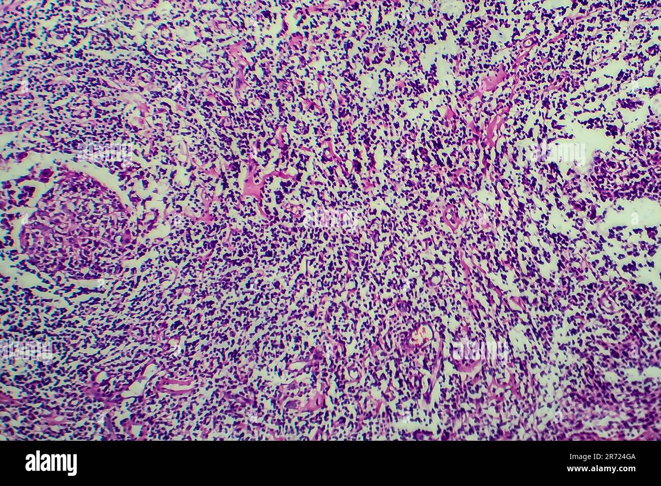 Hodgkin S Lymphoma Light Micrograph Photo Under Microscope Stock