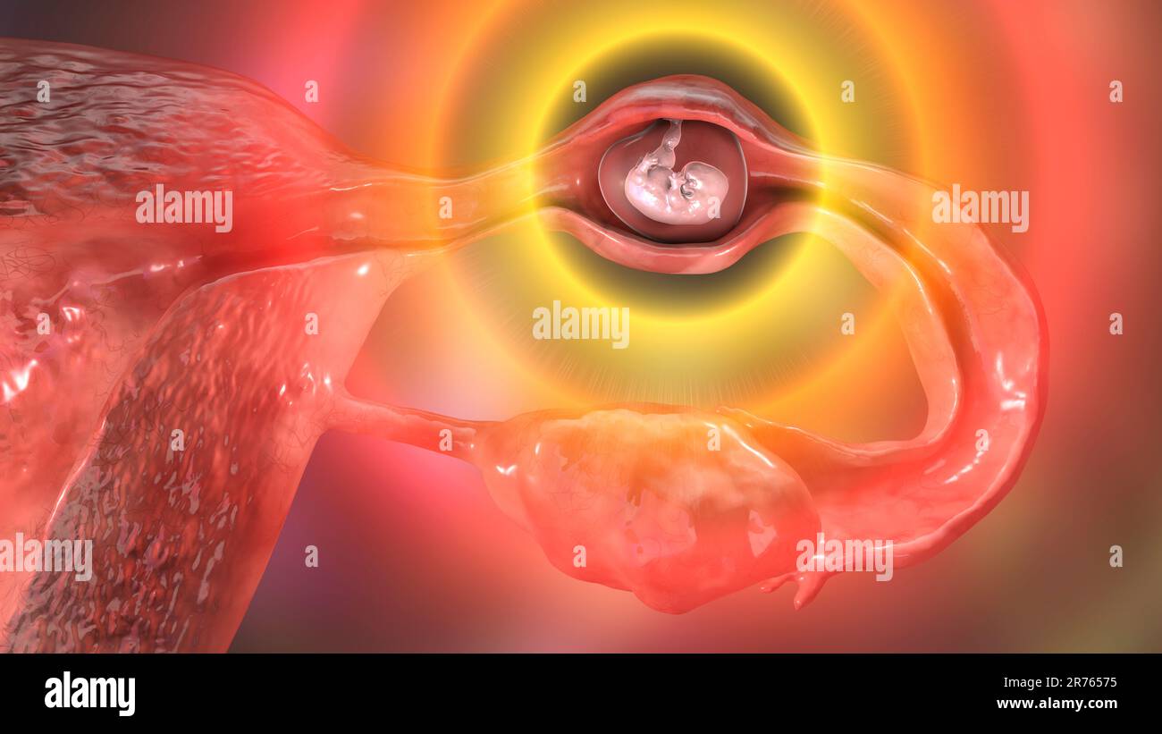 Ectopic Pregnancy Illustration The Embryo Has Implanted In The