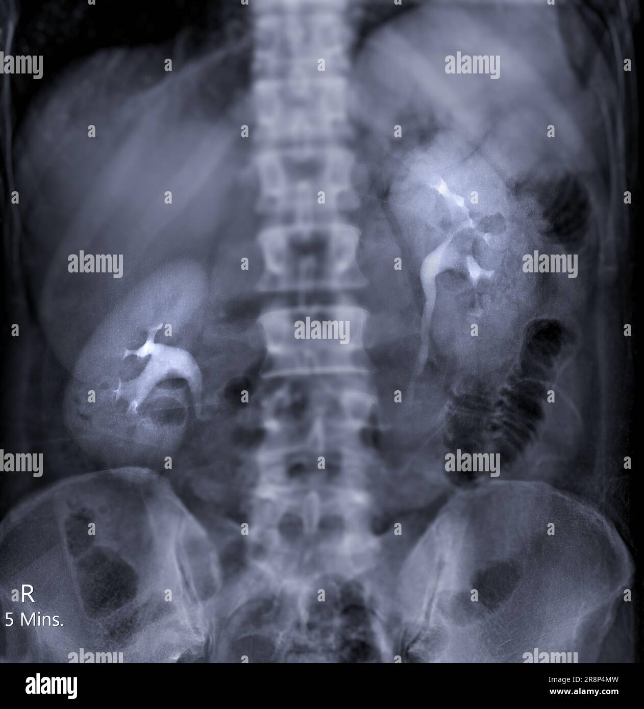 Intravenous Pyelogram Or I V P Is An X Ray Exam Of Urinary Tract After