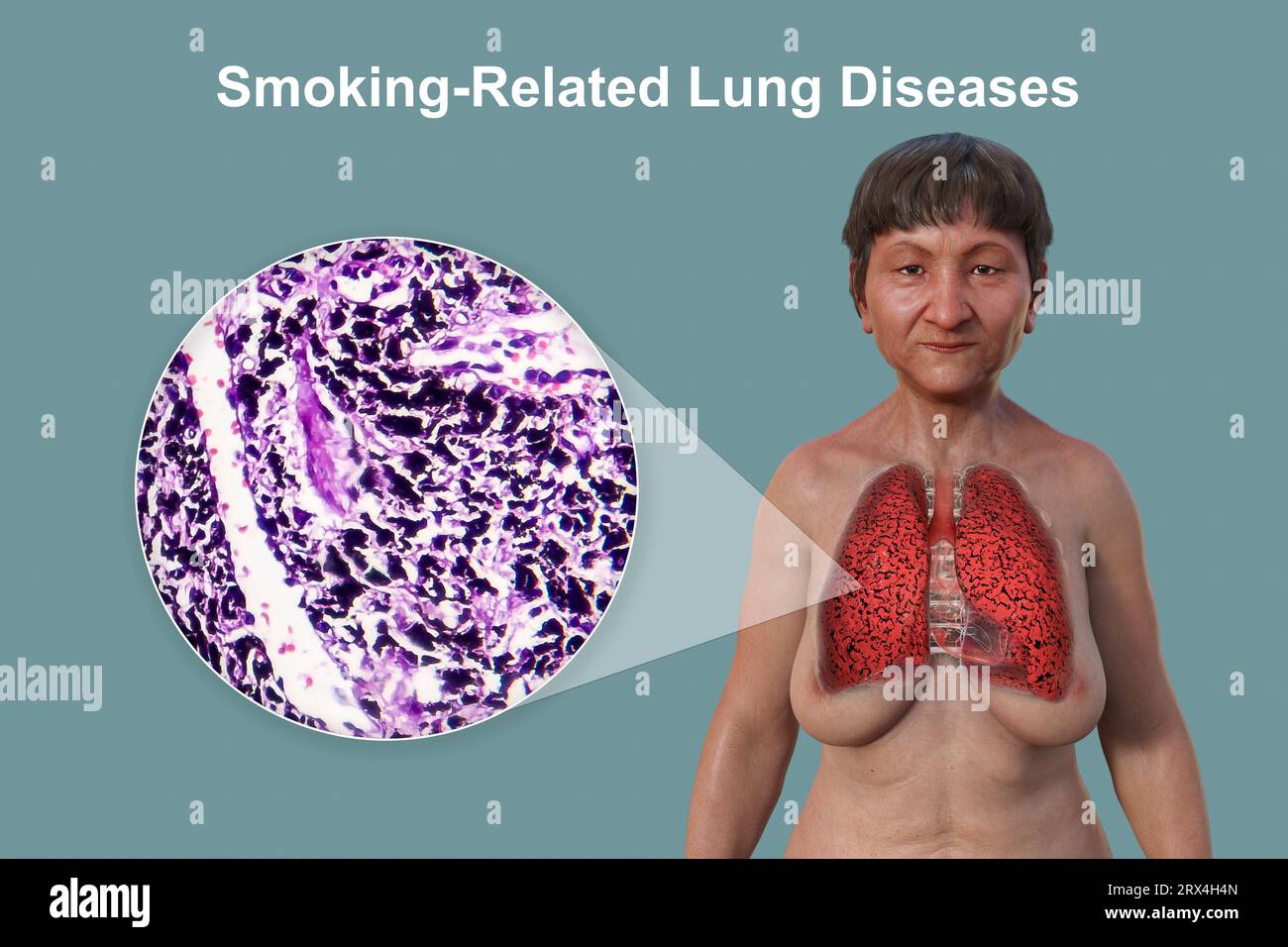 Woman With Transparent Skin Revealing The Condition Of Smoker S Lungs