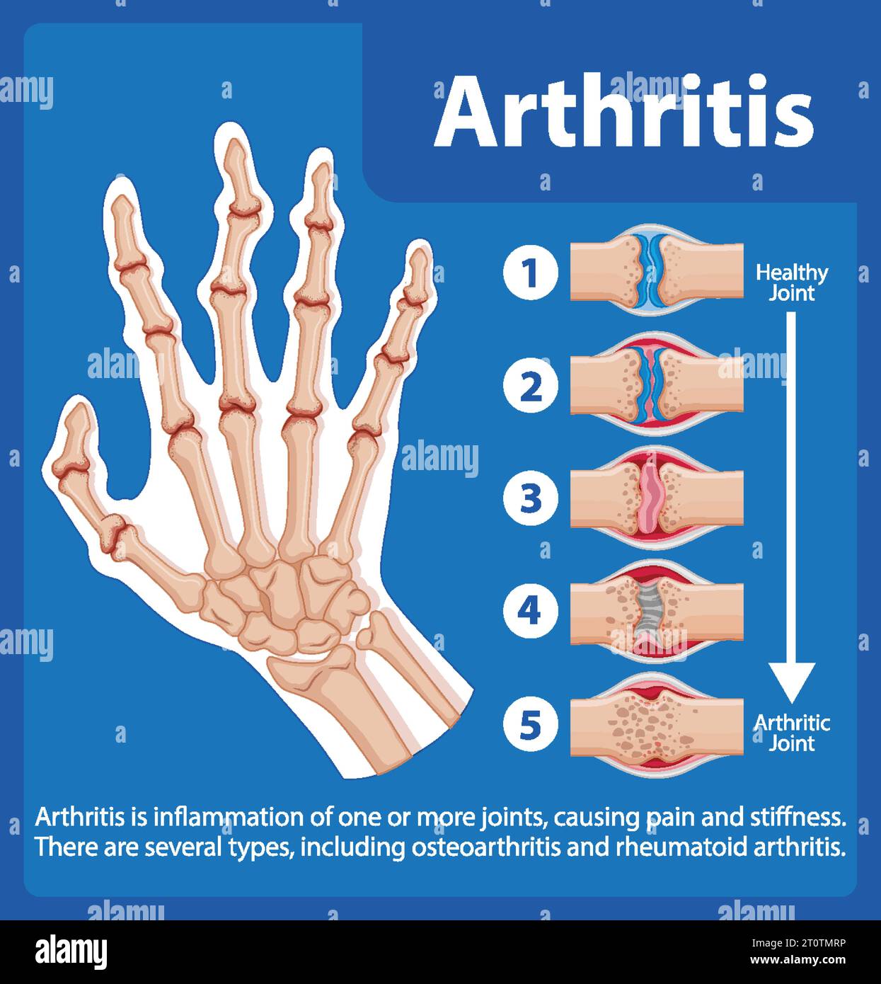 Illustrated Infographic Showcasing Stages Of Arthritis In The Human