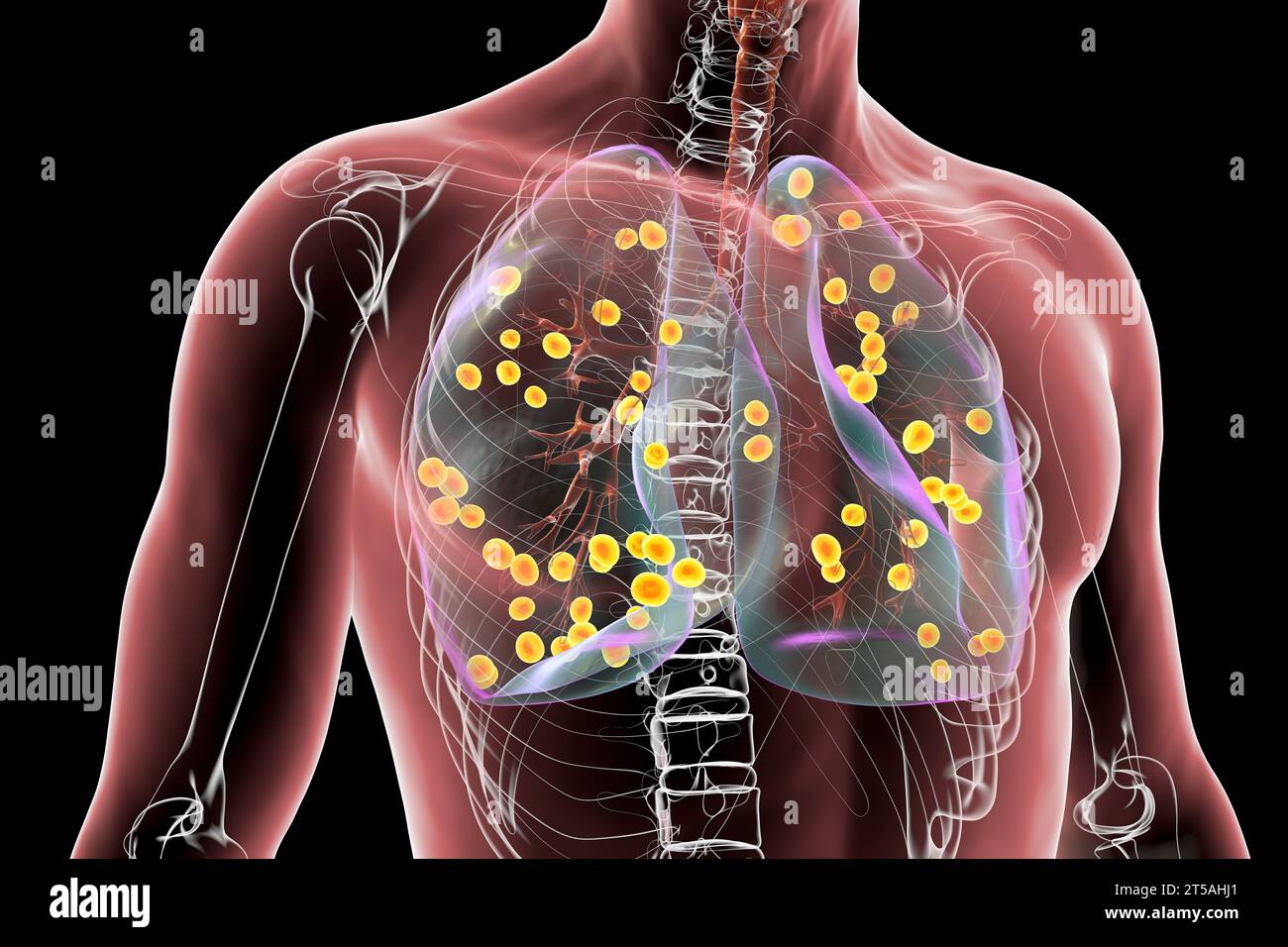 Lung Histoplasmosis A Fungal Infection Caused By Histoplasma