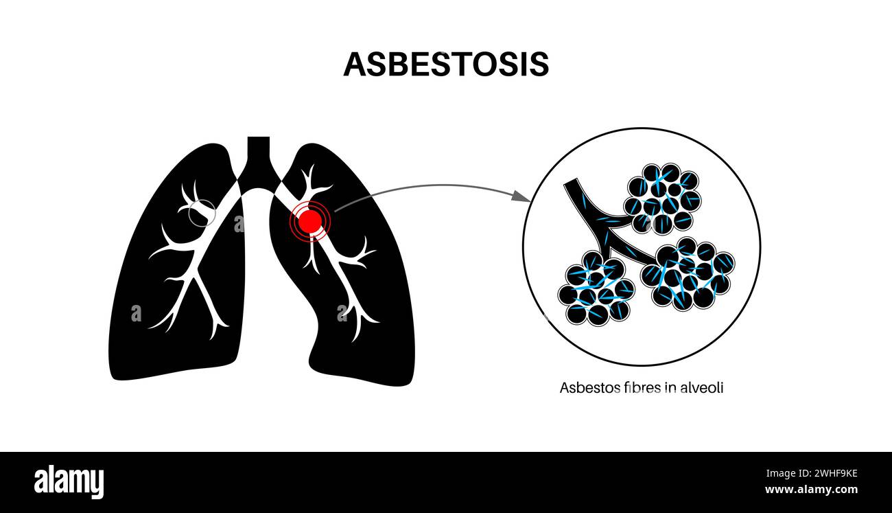 Lung Disease White Background Hi Res Stock Photography And Images Alamy