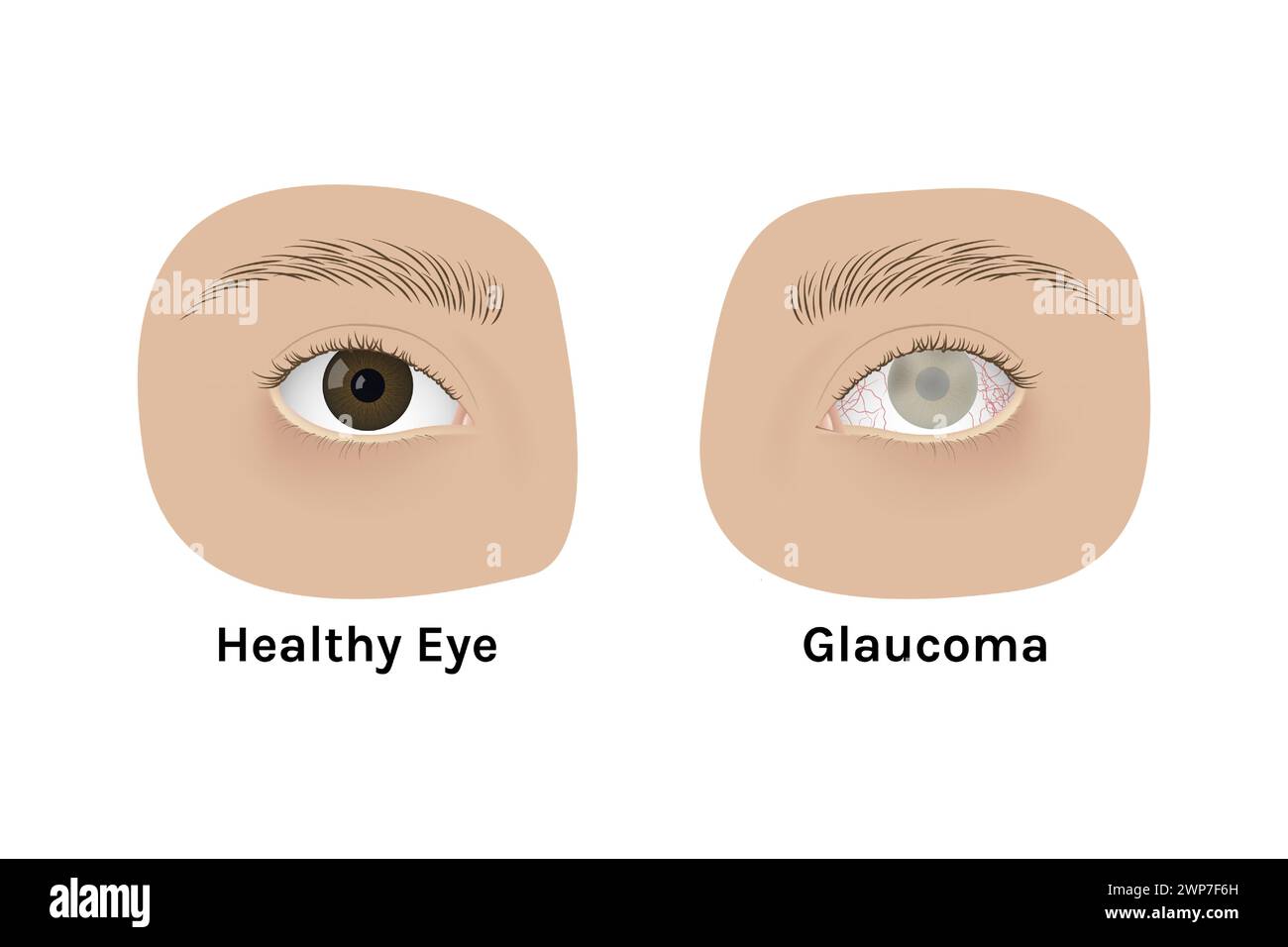 Realistic Human Healthy Eye And With Glaucoma Vector Illustration