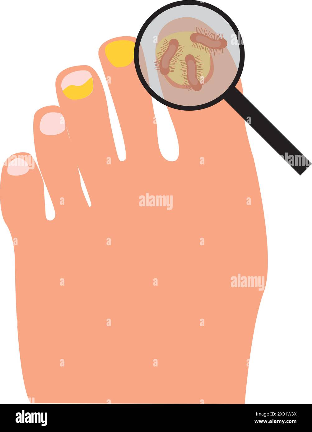 Onychomycosis Feet With Nail Disease Fungal Nails Infection Doctors