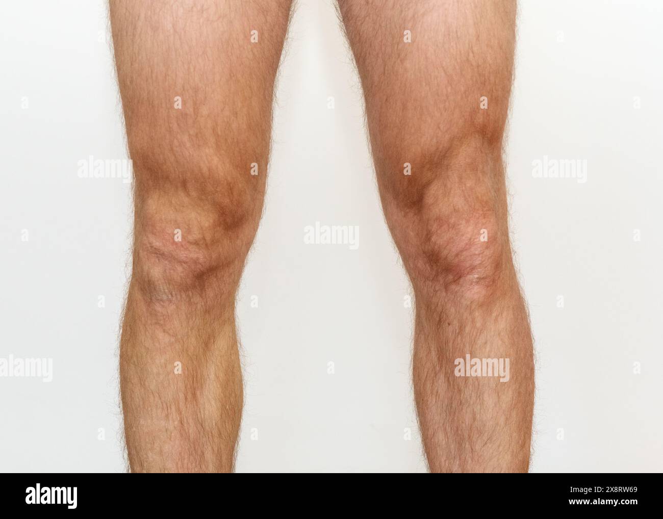 Osgood Schlatter Disease Hi Res Stock Photography And Images Alamy