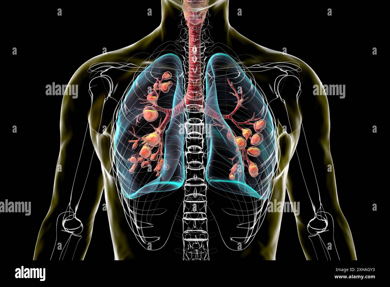 Illustration Of Lungs Affected By Cystic Fibrosis A Genetic Disorder