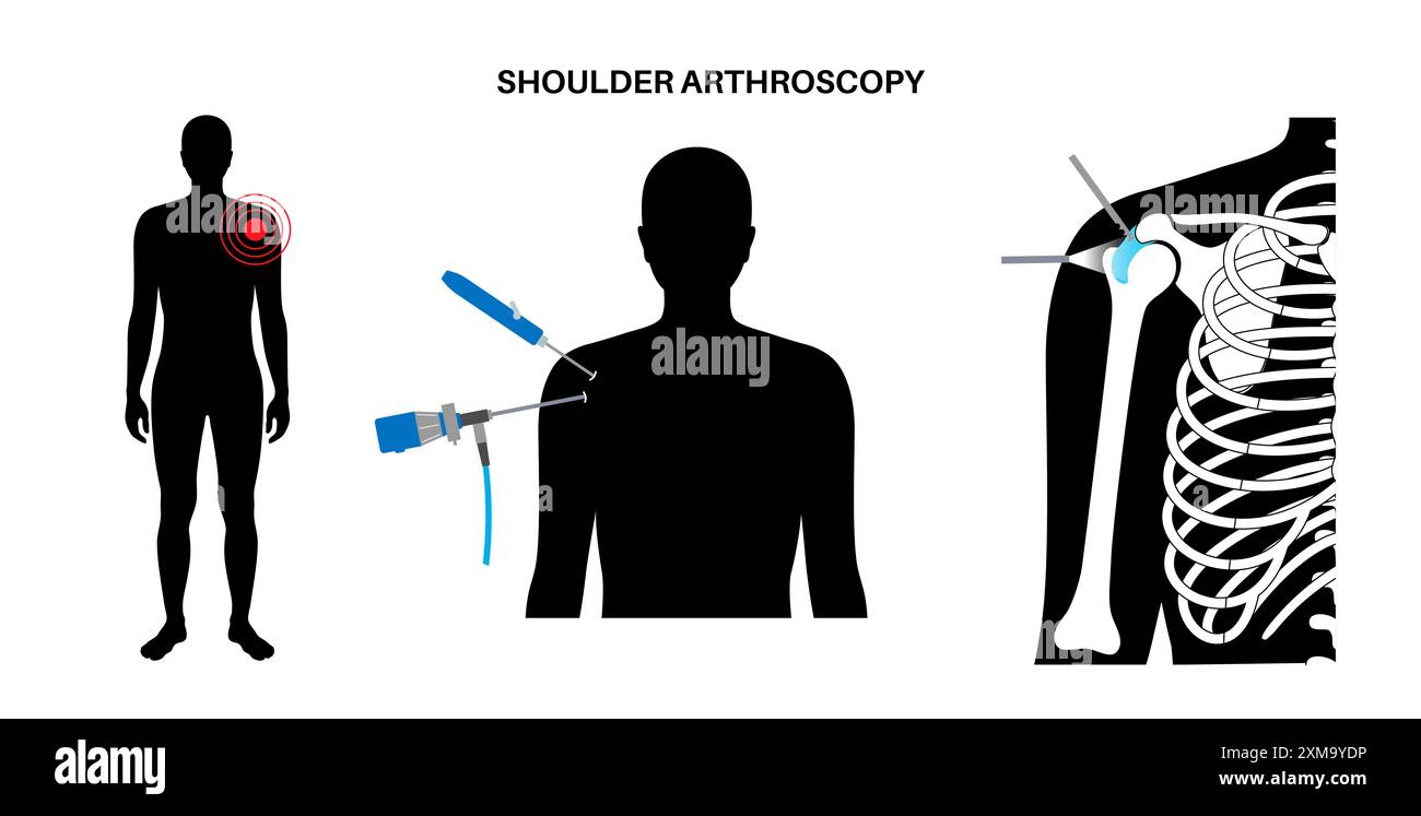 Illustration Of A Shoulder Arthroscopy Procedure This Is A Procedure