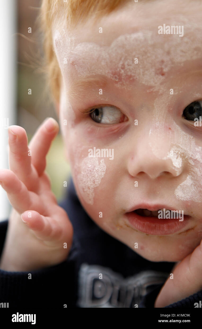 Pictures of Viral Skin Diseases and Problems - Chickenpox ...