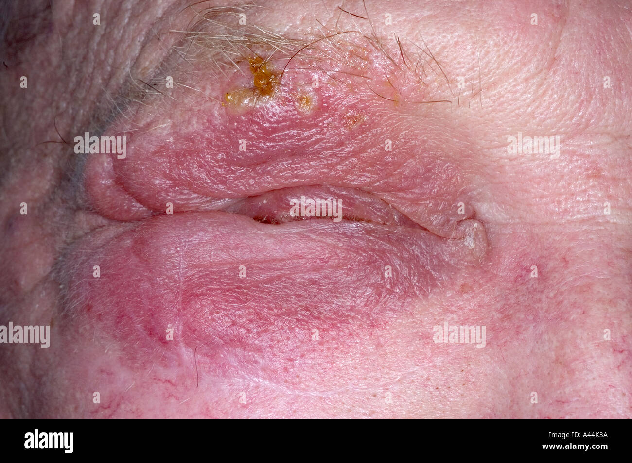 herpes rash on face