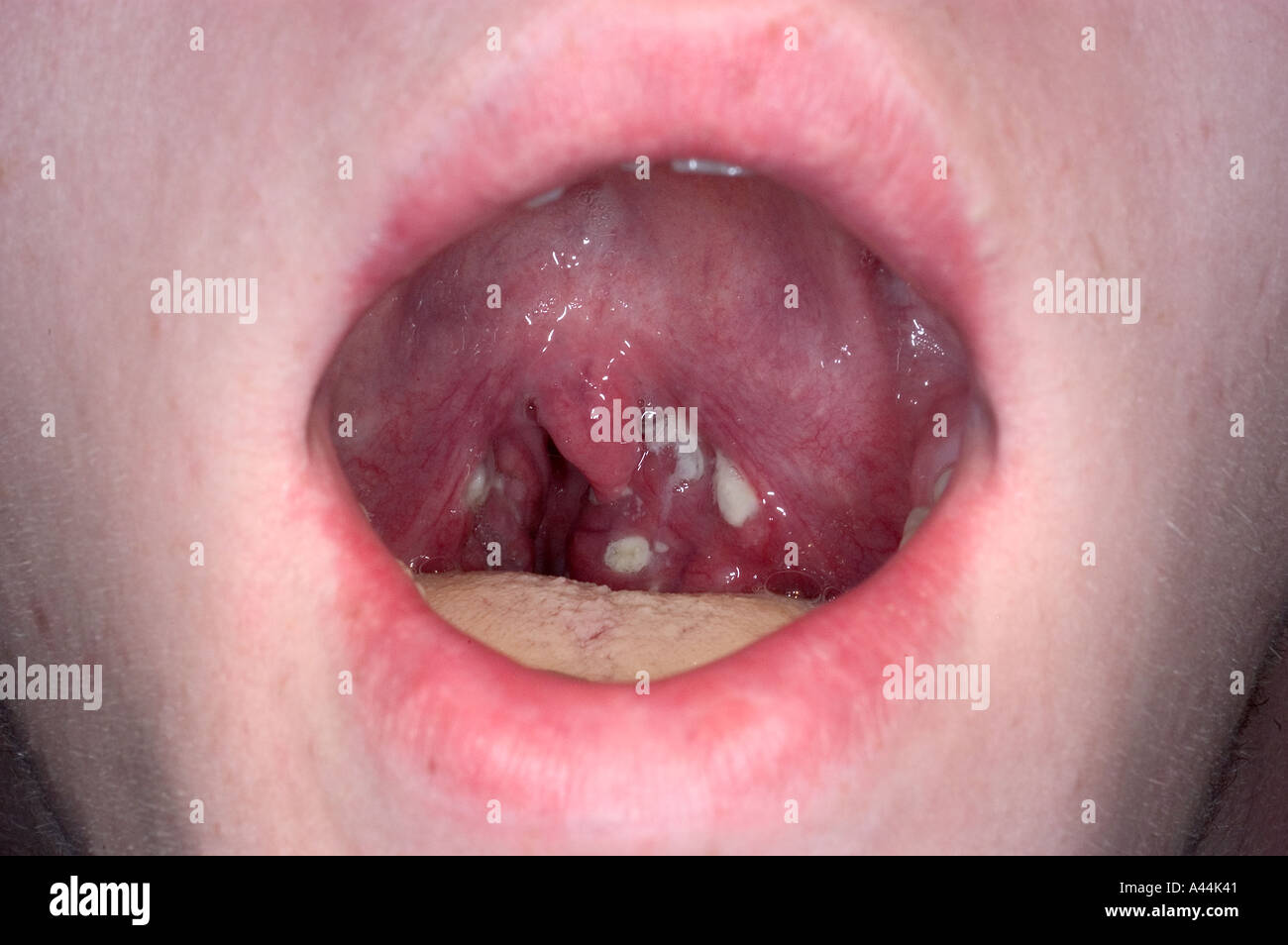 Photo Of Strep Throat 23