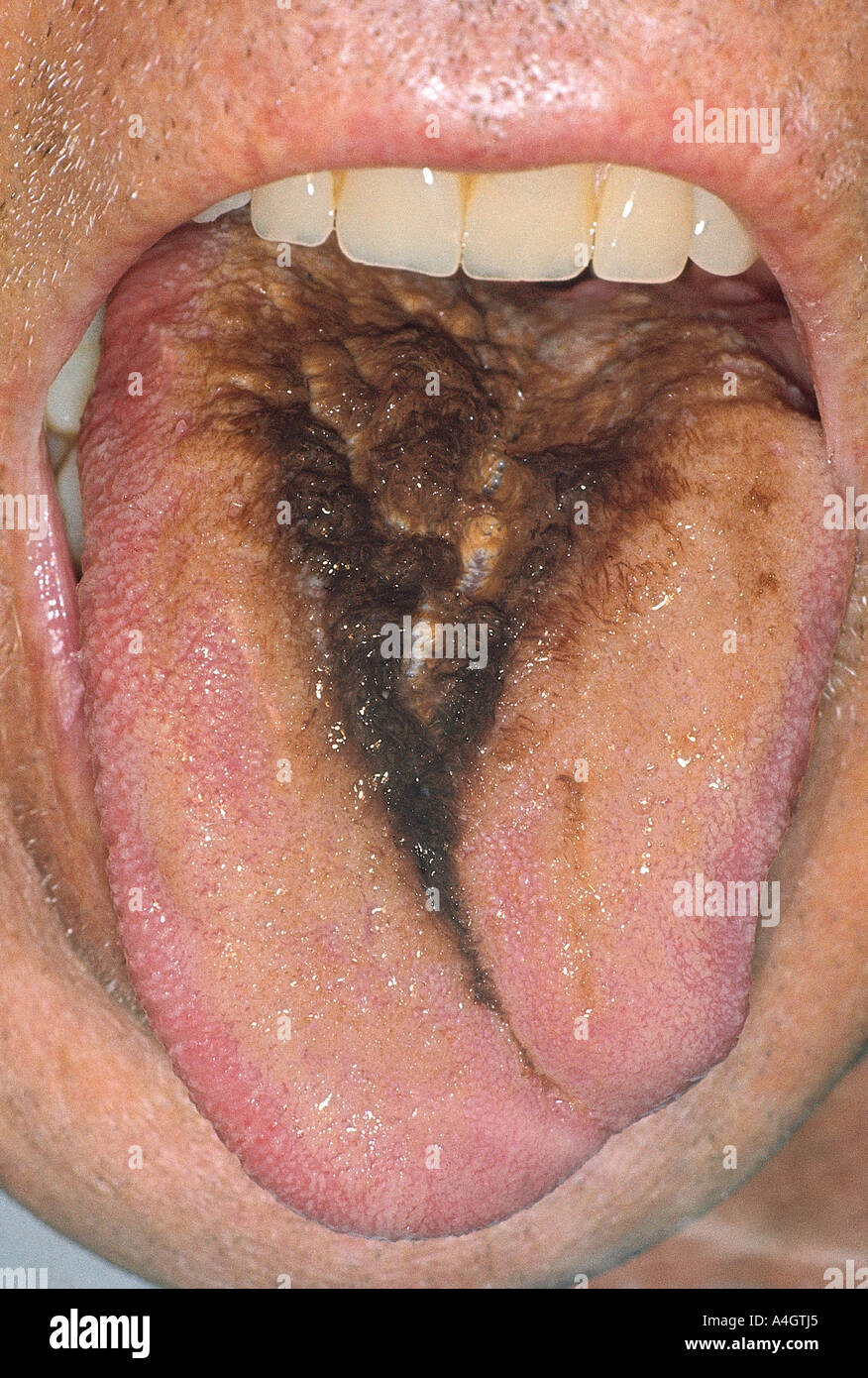 Hairy Tongue Picture 66
