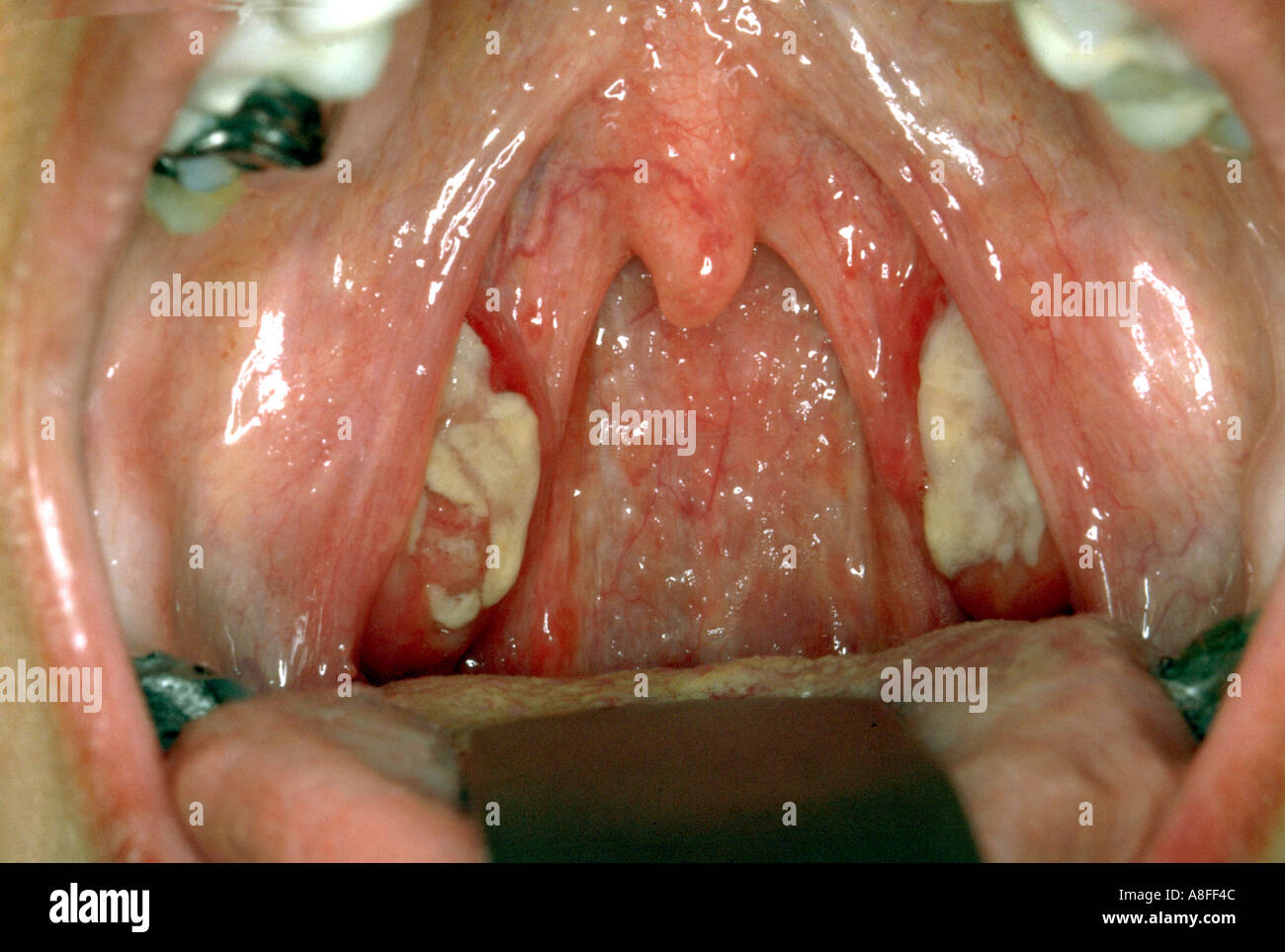 Sore Throat Images - Photos - Pictures - Page 3