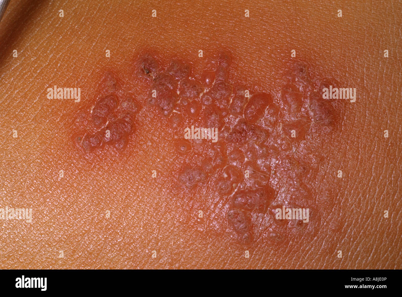 herpes-zoster-on-a-childs-back-herpes-virus-varicella-stock-photo
