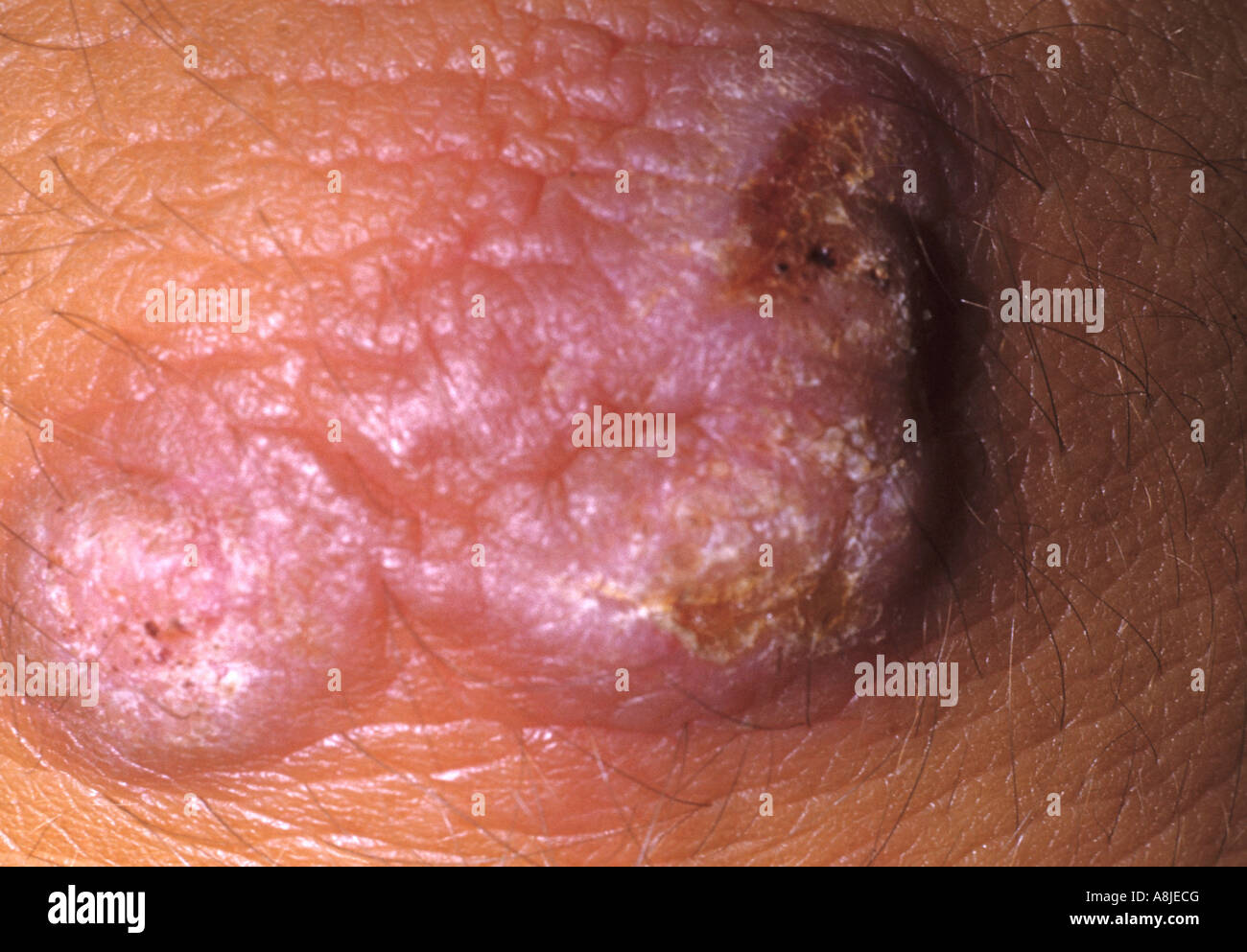 wart virus