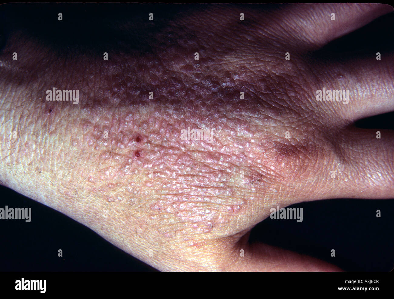 Contact Dermatitis On Hand Eczematous Stock Photo Royalty Free Image