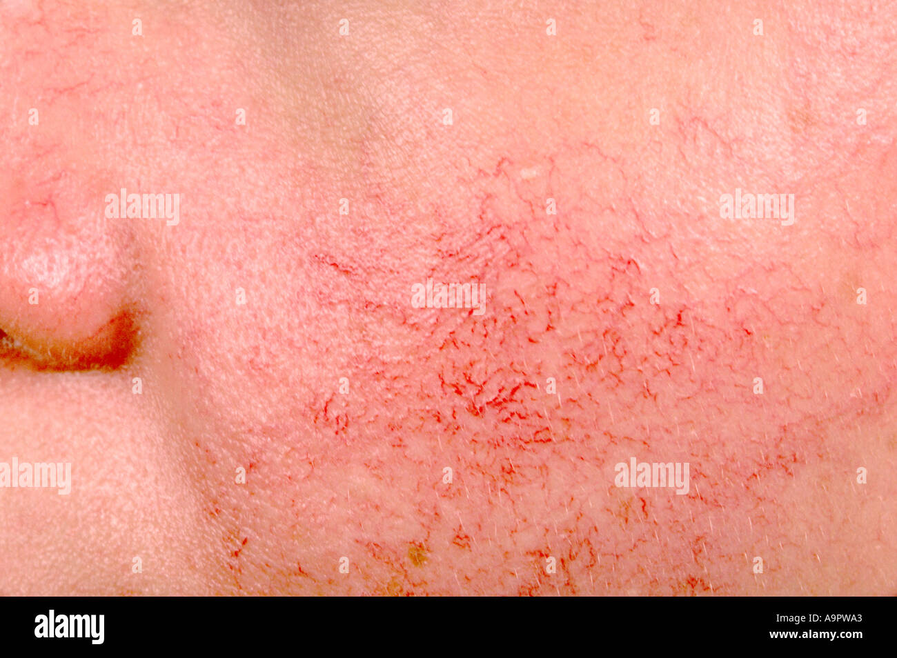 Telangiectasis Stock Photo, Royalty Free Image 4055458 Alamy