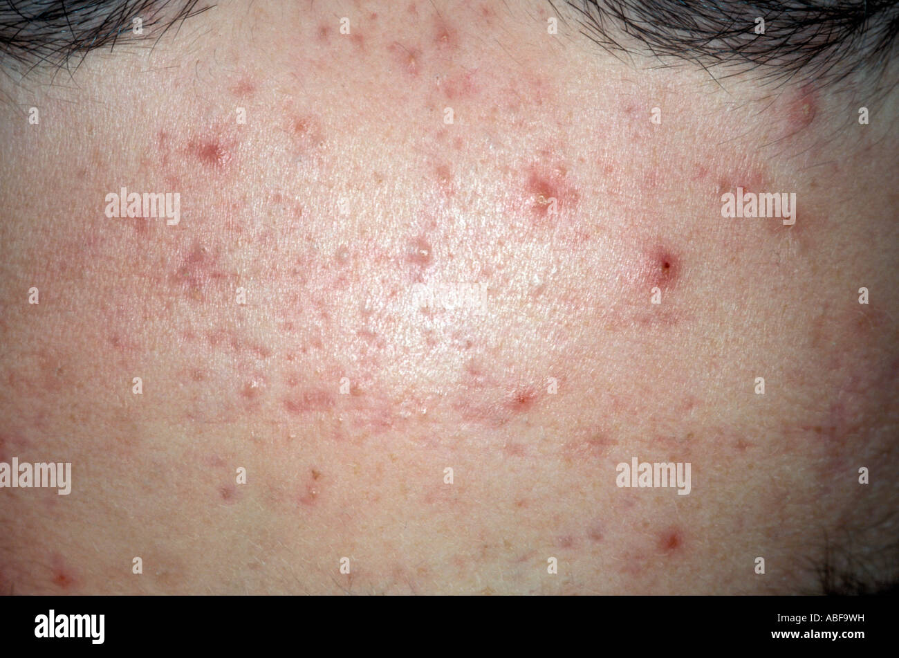 What does acne look like What does acne look like