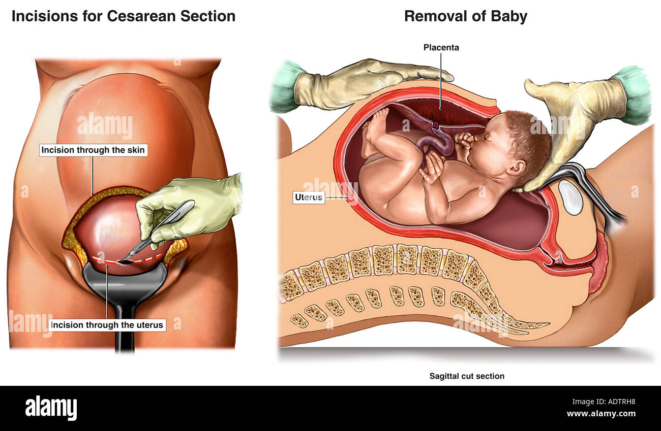 Vaginal birth breech position