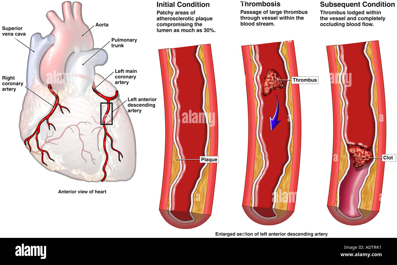 Deep vein thrombosis penis