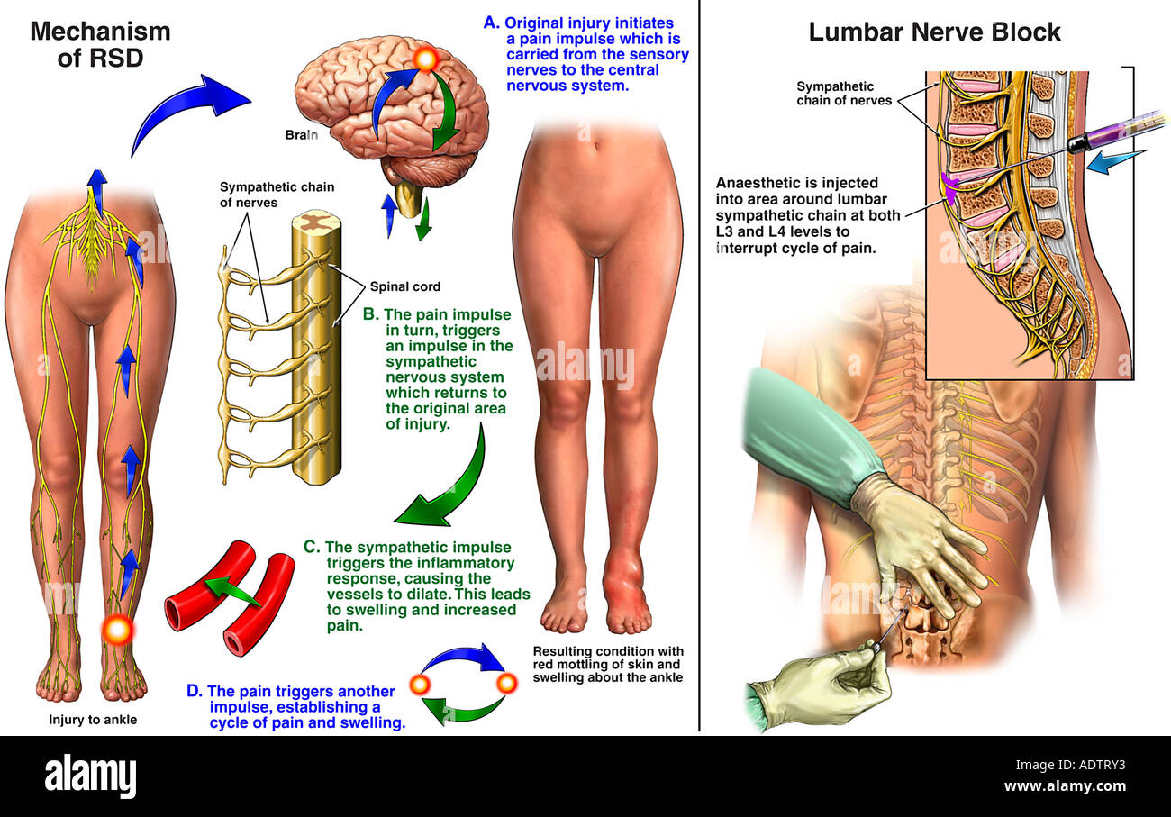 Reflex Sympathetic Dystrophy Levitra