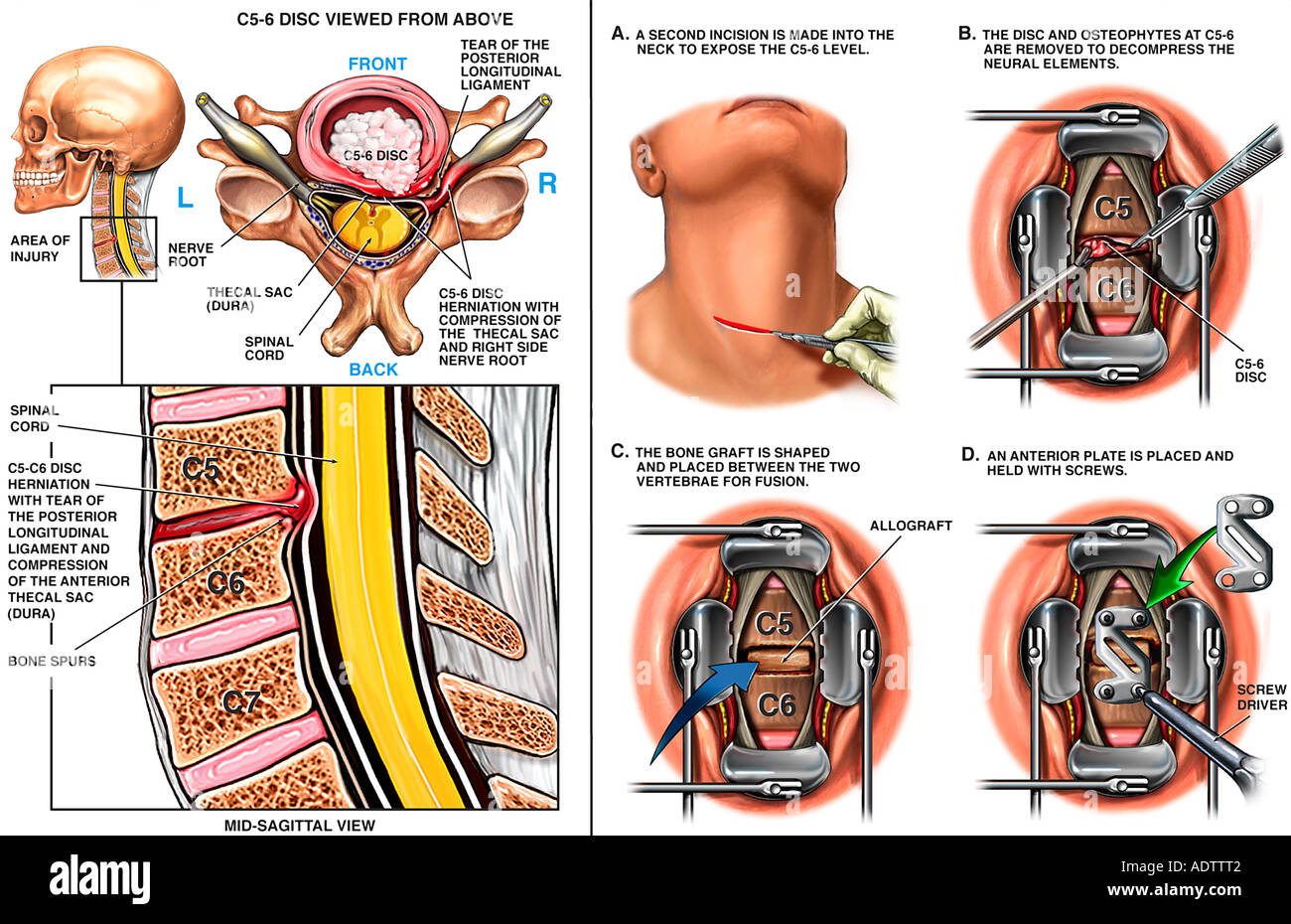 C5 6 Anterior Cervical Discectomy And Spinal Fusion Surgery Stock Photo 