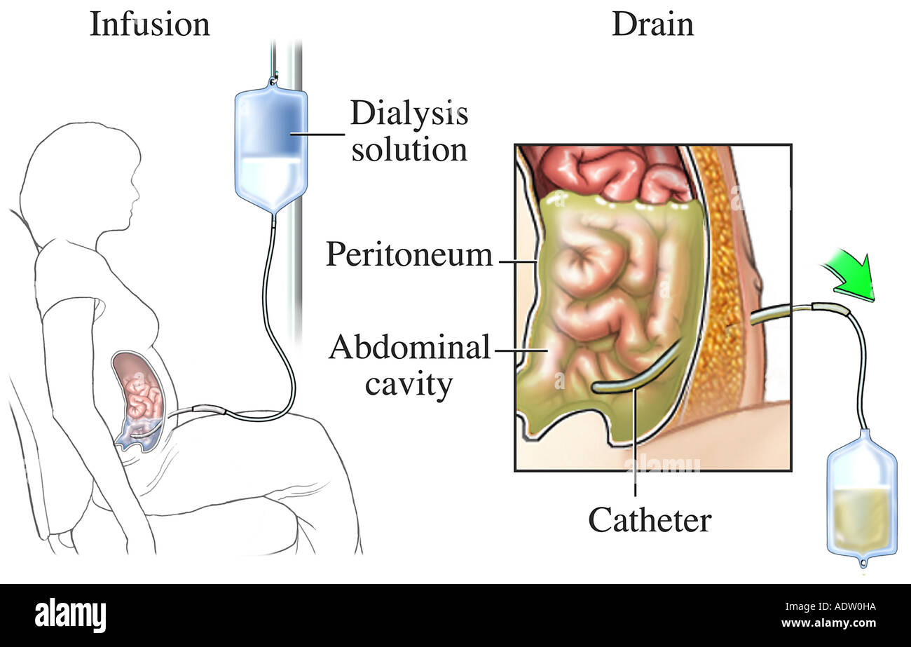 Peritoneal Dialysis Stock Photo, Royalty Free Image 7711001 Alamy