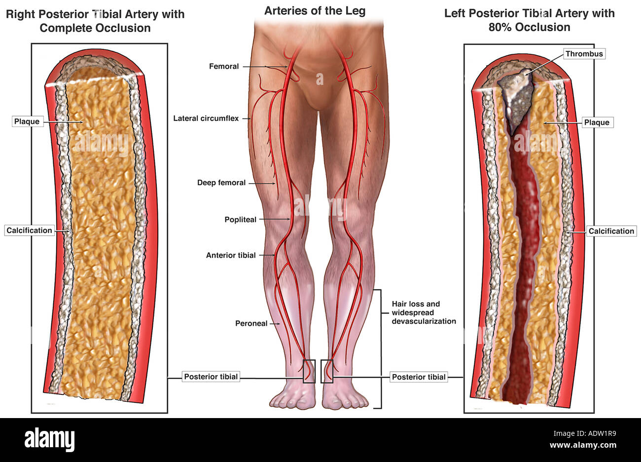 Blood Vessel Blockage Of The Lower Legs Stock Photo 7711288 Alamy
