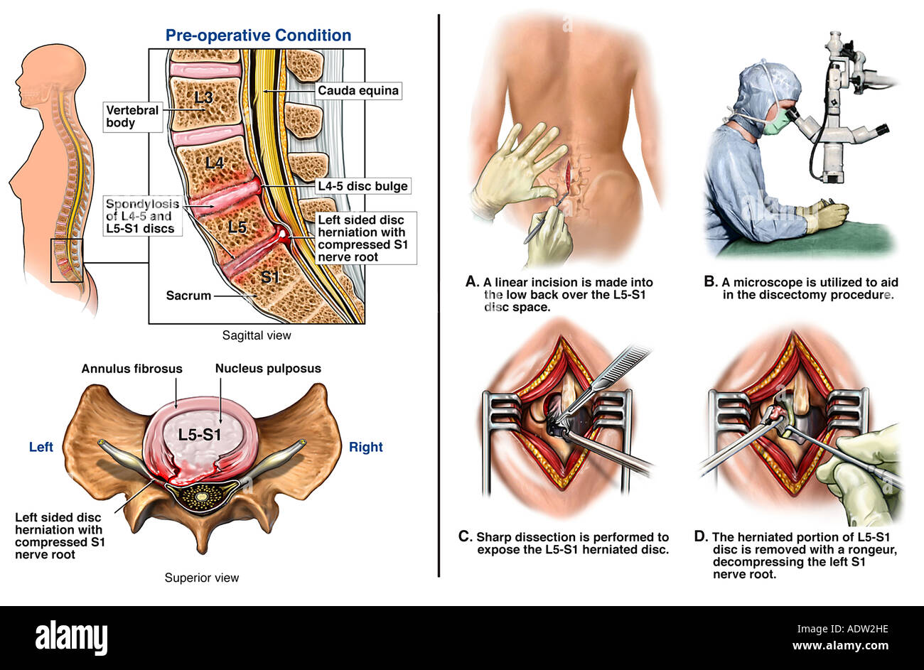L S Lumbar Disc Herniation With Microdiscectomy Repair Stock Photo