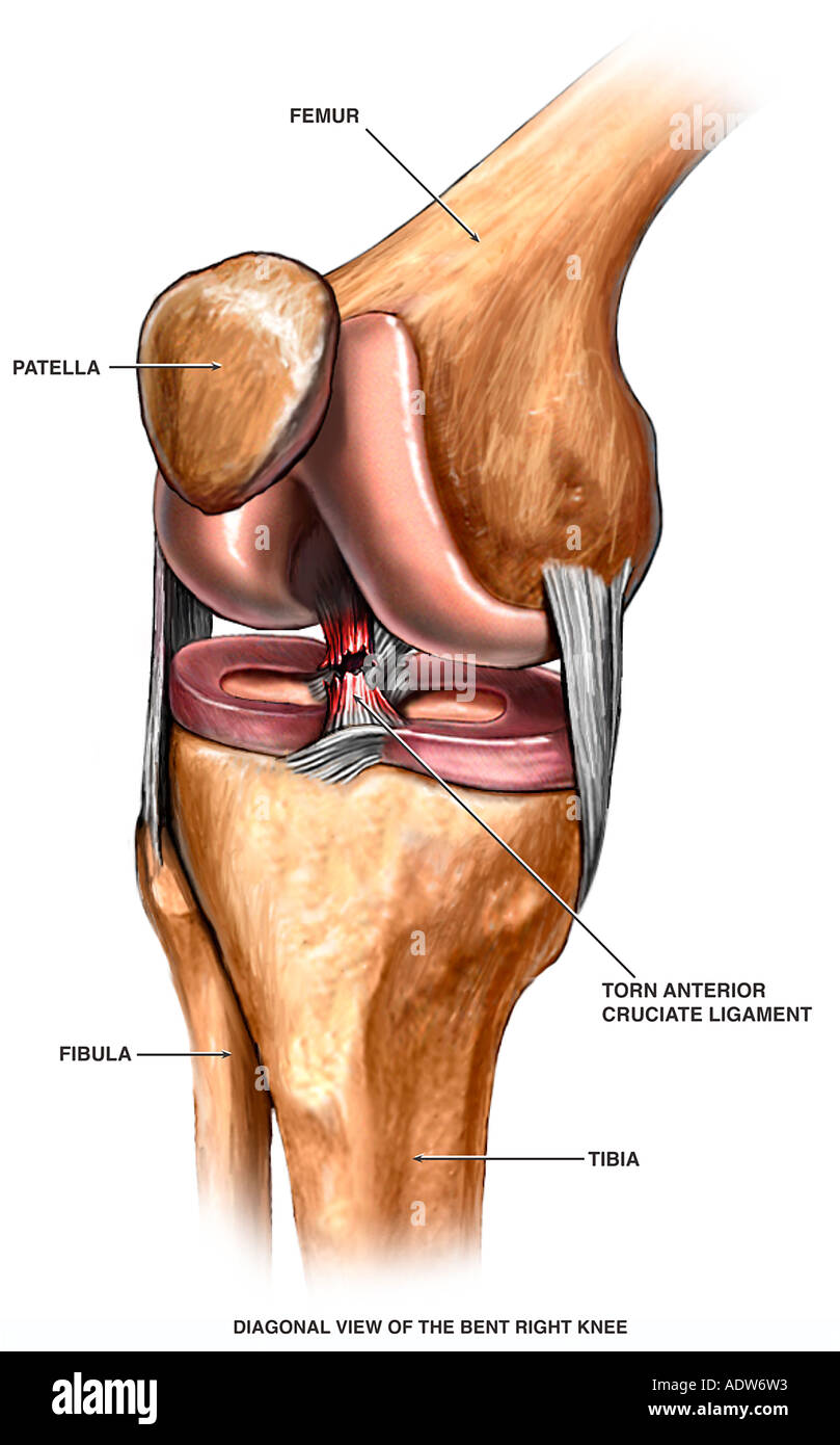 a description of anterior crucial ligament acl and its injuries Surgery for anterior cruciate ligament deficiency: cruciate ligament resulted in abnormal anterior the first description of a clinical case of acl injury in. a description of anterior crucial ligament acl and its injuries Surgery for anterior cruciate ligament deficiency: cruciate ligament resulted in abnormal anterior the first description of a clinical case of acl injury in.