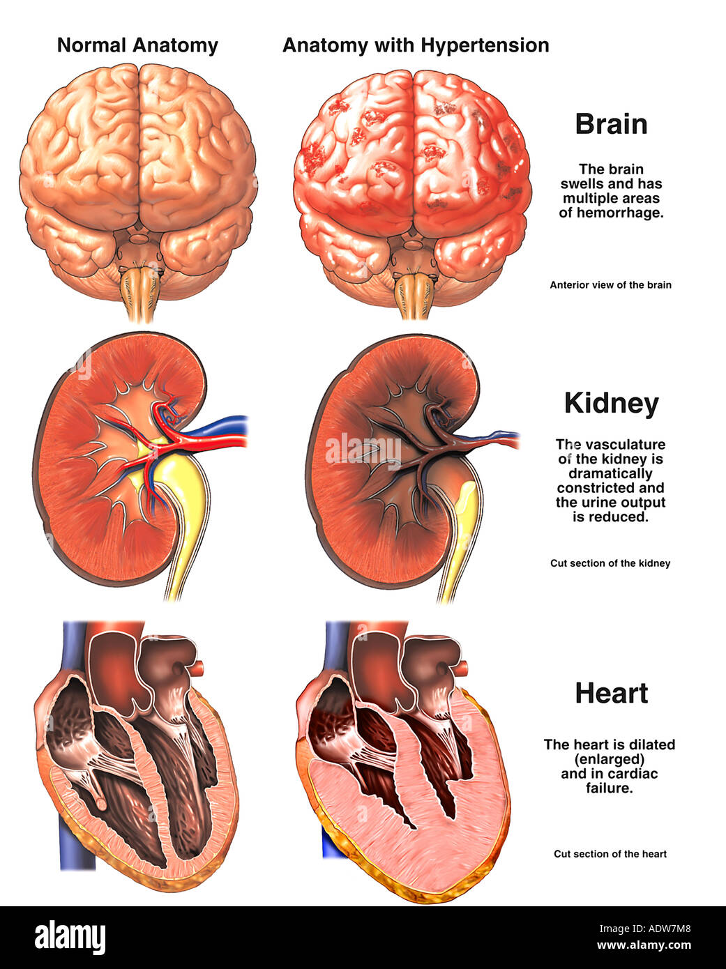 capoten high blood pressure